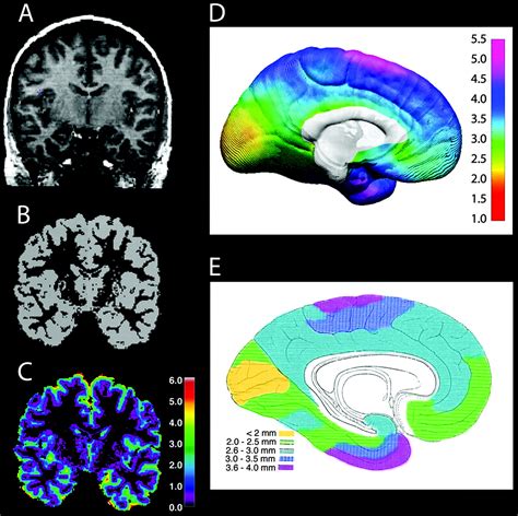 Longitudinal Mapping of Cortical Thickness Measurements: An 